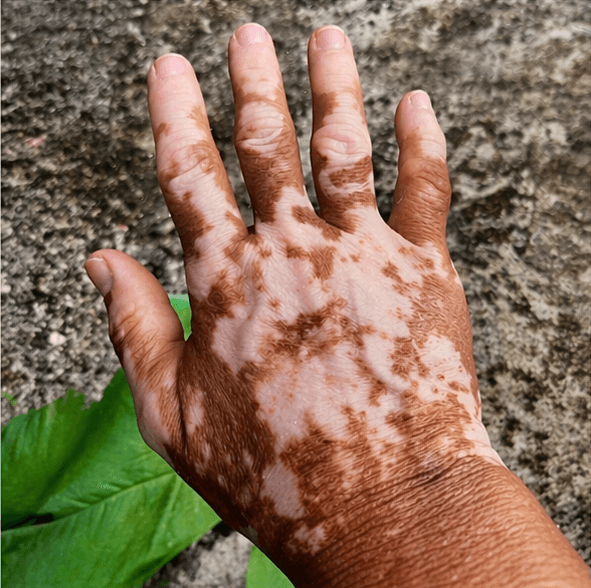 Vitiligo — Antes (foto 1)