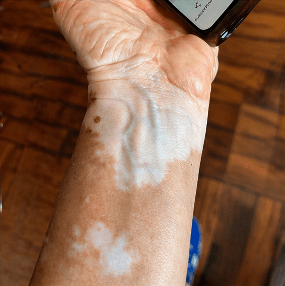 Vitiligo — Depois (foto 2)